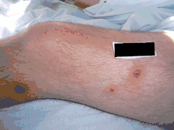 Pustular lesions with central necrosis on the left leg of a patient with Sweet's syndrome associated with Crohn's disease