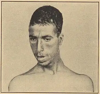 Oxycephaly in congenital syphilis