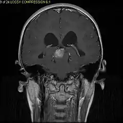 T1-weighted coronal MRI image postcontrast showing heterogeneous contrast enhancement within the presumed tectal plate glioma