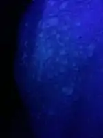 Wood's lamp: fluorescence of pityriasis versicolor