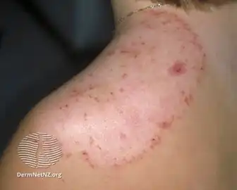 Tinea corporis