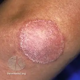 Tinea corporis