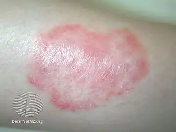 Tinea corporis