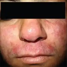 Tinea incognita