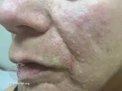 Tuberous sclerosis angiofibromas