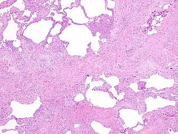 Appearance of usual interstitial pneumonia (UIP) in a surgical lung biopsy at low magnification. The tissue is stained with hematoxylin (purple dye) and eosin (pink dye) to make it visible. The pink areas in this picture represent lung fibrosis (collagen stains pink). Note the "patchwork" (quilt-like) pattern of the fibrosis.