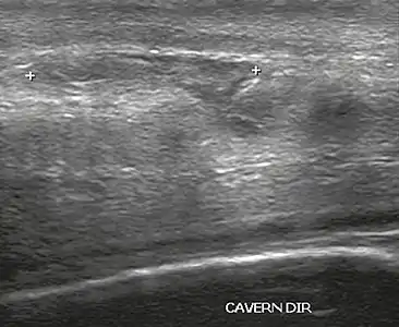 Figure 4 A: Ultrasound of the penis, right lateral view. Longitudinal section showing rupture of the tunica albuginea with an adjacent 1.92 cm hematoma (between calipers), due to trauma.