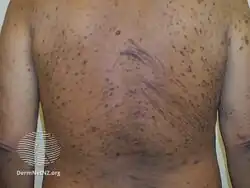 Uremic pruritus