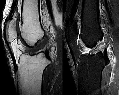 Anterior cruciate ligament tear seen on MRI. T1 left, right PDW.