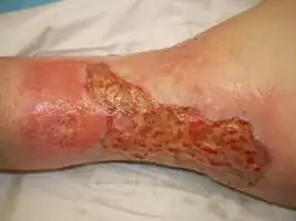 Venous ulcer