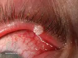 Viral wart