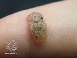 Viral wart