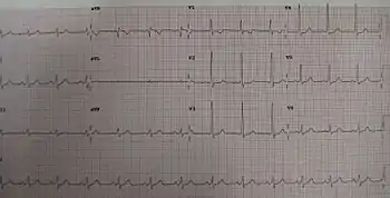 A short PR in Wolff–Parkinson–White syndrome