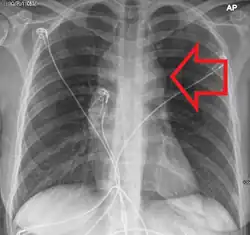 A widened mediastinum due to lymphoma