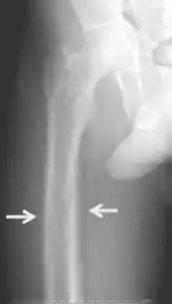 Projectional radiography ("X-ray") of periosteal reaction.