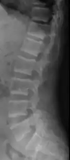 X-ray of a subtle "rugger jersey spine" due to sclerotic bands adjacent to the vertebral endplates.