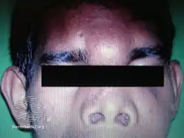 Mucomycosis of skin of forehead