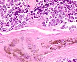 A high power of melanotic neuroectodermal tumor of infancy showing pigmented large epithelioid cells and smaller primitive cells (hematoxylin and eosin stain).