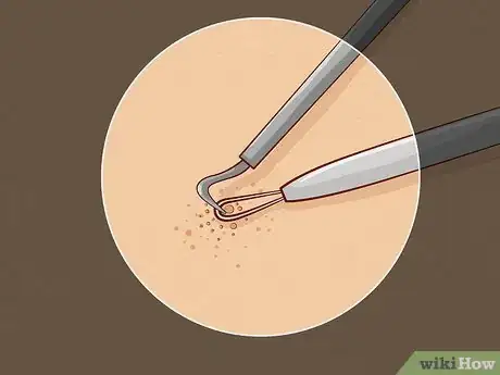 Immagine titolata Close Blackhead Holes Step 12