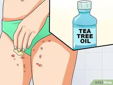 Immagine titolata Ease Herpes Pain with Home Remedies Step 9