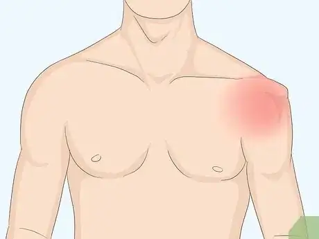 Immagine titolata Fix a Dislocated Shoulder Step 1