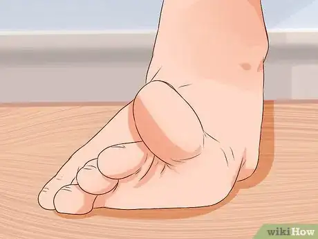 Immagine titolata Relieve Bunions Step 9