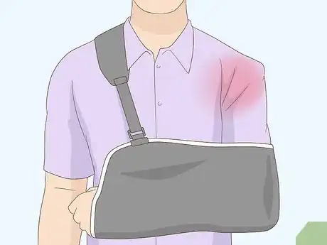 Immagine titolata Fix a Dislocated Shoulder Step 2