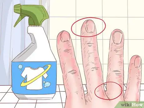 Immagine titolata Treat Hand Eczema Step 2