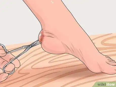 Immagine titolata Care for a Burst Blister Step 10