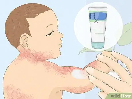 Immagine titolata Treat Baby Heat Rash Step 11