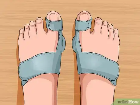 Immagine titolata Get Rid of Bunions Step 8
