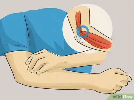 Immagine titolata Assess Forearm Tendinitis Step 3