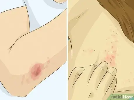 Immagine titolata Cure a Fever at Home Step 18