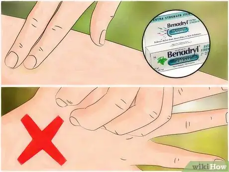 Immagine titolata Identify Insect Bites Step 10