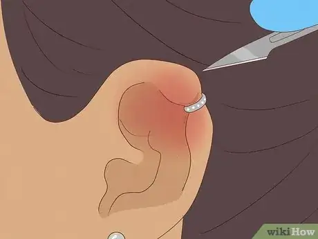 Immagine titolata Treat an Infected Ear Piercing Step 8