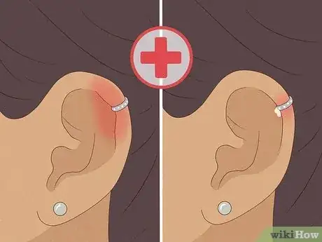 Immagine titolata Treat an Infected Ear Piercing Step 5