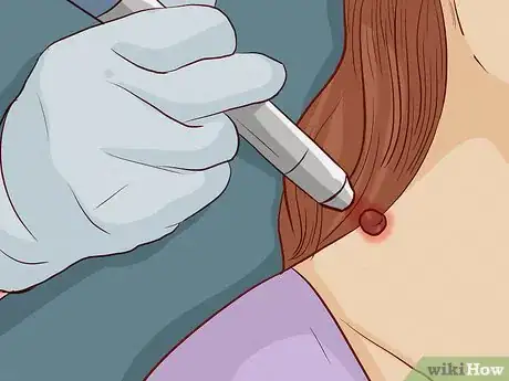 Immagine titolata Remove a Skin Tag from Your Neck Step 4