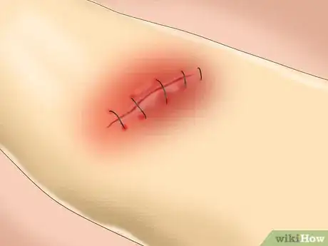 Immagine titolata Clean a Wound Without Proper Supplies Step 7