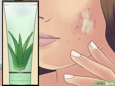 Immagine titolata Get Rid of Cystic Acne Scars Step 3