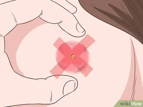 Immagine titolata Get Rid of an Abscess Step 1