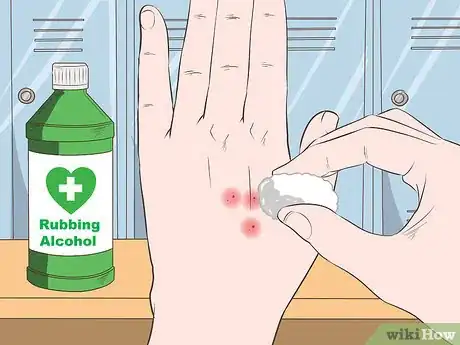 Immagine titolata Stop Mosquito Bites from Itching Step 9