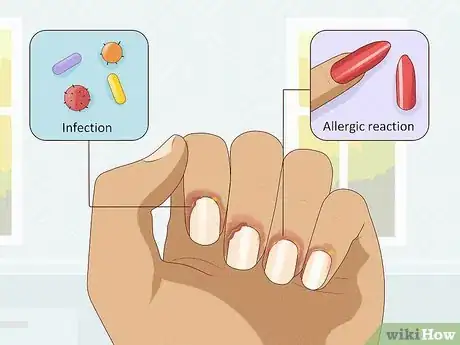 Immagine titolata Stop Itchy Cuticles Step 1