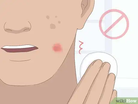 Immagine titolata Apply Calamine Lotion Step 12