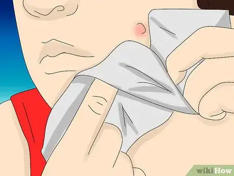 Immagine titolata Painlessly Pop a Pimple Step 7