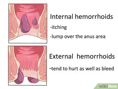 Immagine titolata Get Rid of Hemorrhoids Naturally Step 1