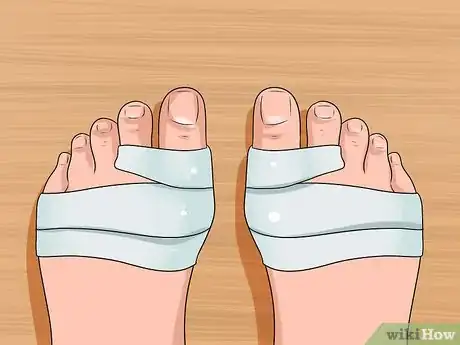 Immagine titolata Get Rid of Bunions Step 6
