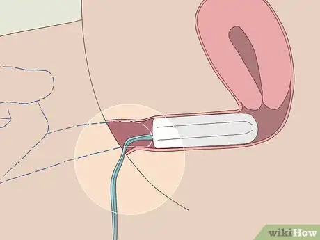 Immagine titolata Insert a Tampon Without Applicator Step 9