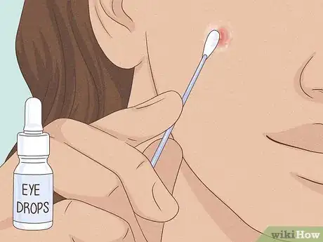 Immagine titolata Get Rid of a Zit Overnight Step 9