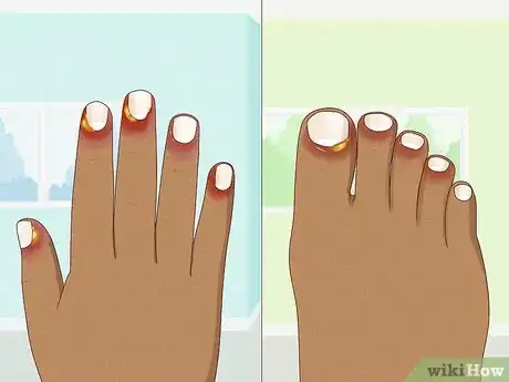 Immagine titolata Stop Itchy Cuticles Step 2