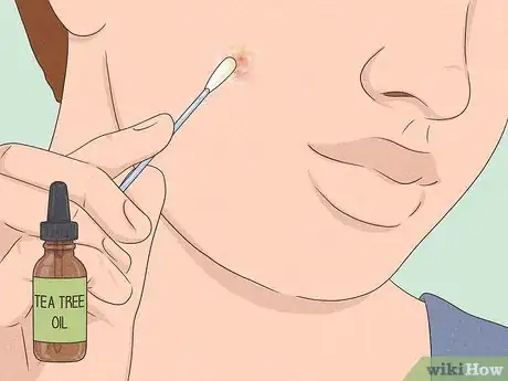 Immagine titolata Get Rid of a Zit Overnight Step 4